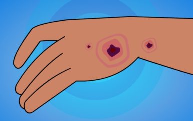Symptom of Diabetes: Slow-healing sores or frequent infections