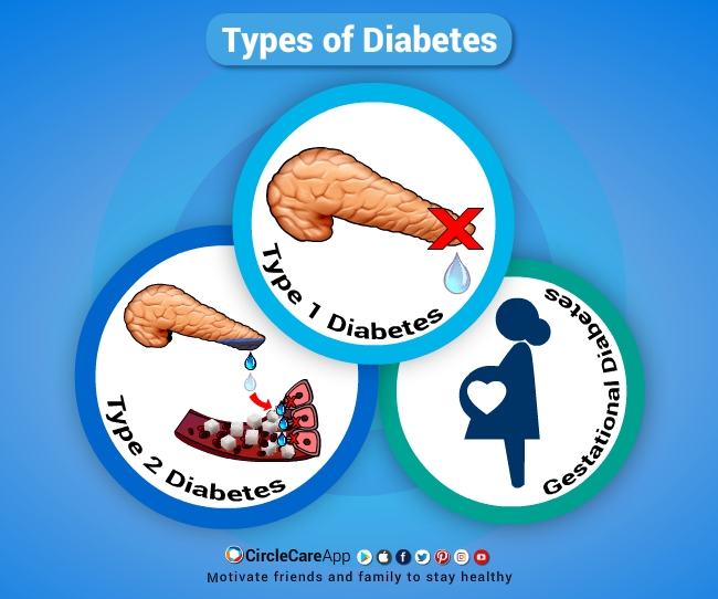 How Many Different Types Of Diabetes Are There CircleCare how-many-different-types-of-diabetes-are-there-circlecare
