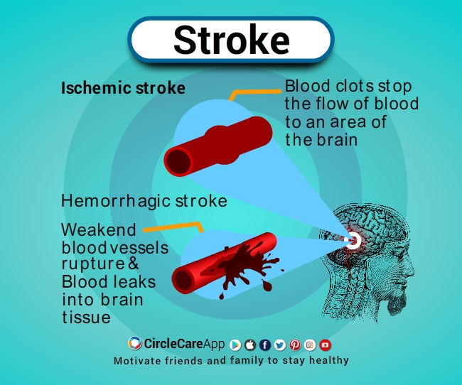 Diabetes-Complications-Storke-CircleCare