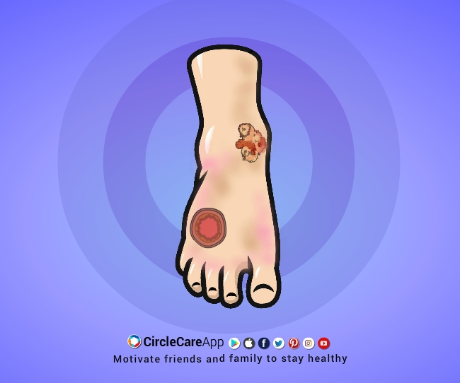 Diabetes-FOOT-COMPLICATIONS-CircleCare