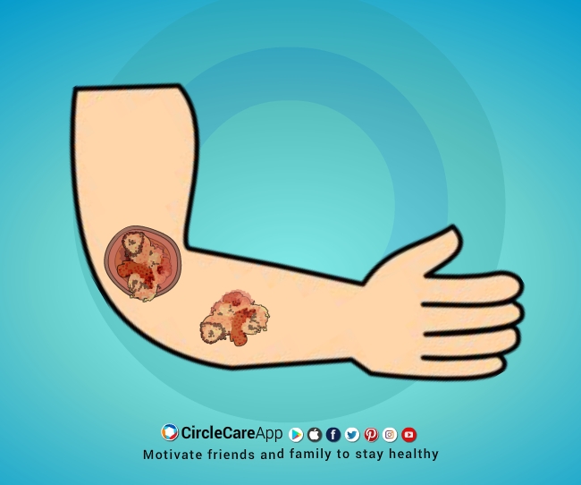 Diabetes-SKIN-COMPLICATIONS-CircleCare