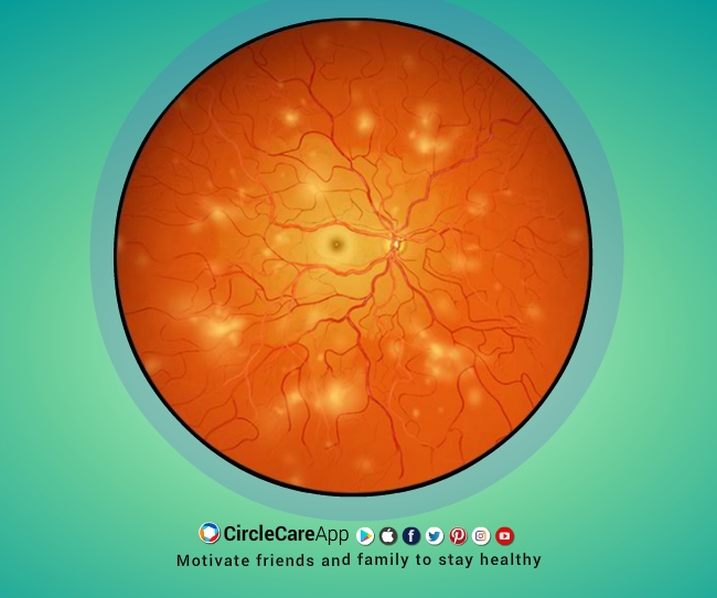 diabetes Eye complications-CircleCare