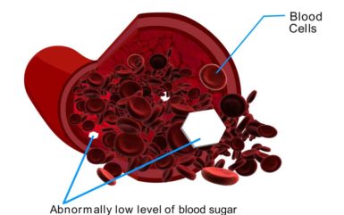 What is Diabetic Hypoglycemia?