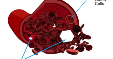 Diabetic-Hypoglycemia