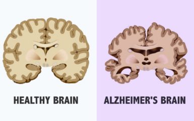 What are the 4 stages of Alzheimer and their effects?