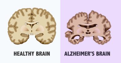 Effect-of-Alzheimer-by-Stages