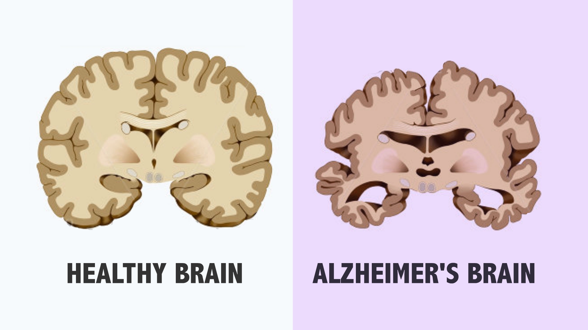 Alzheimers Stages Chart