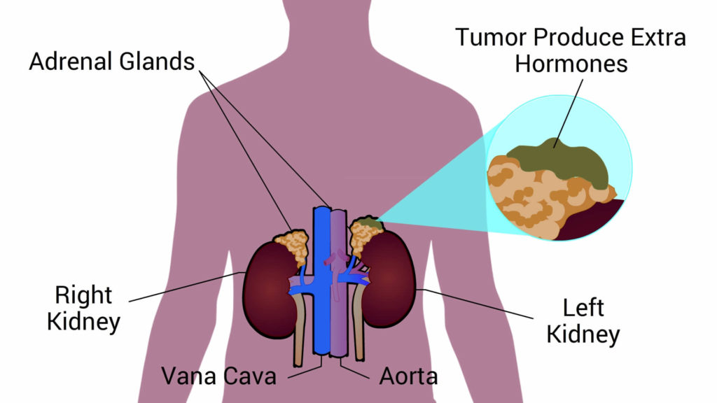 Cause-of-hypertension-Adrenal-gland-tumor-CircleCare