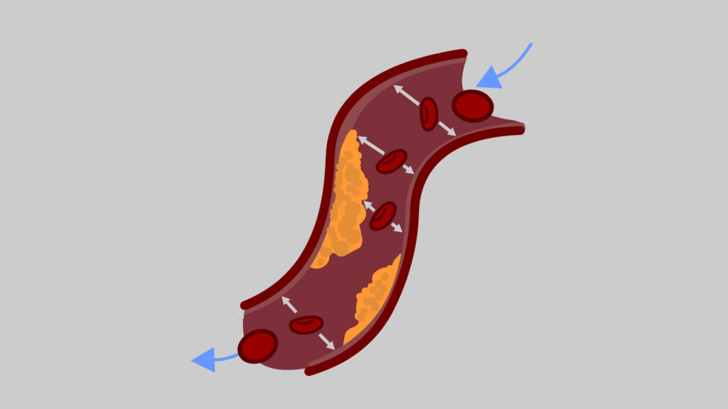 Cause-of-hypertension-Arteries-blood-vessels-CircleCare