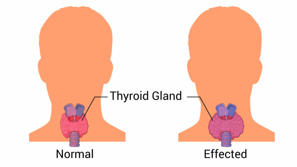 Cause-of-hypertension-thyroid-disease-CircleCare