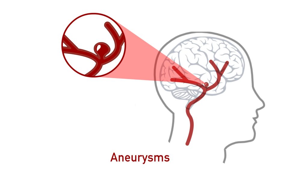 Hypertension-complication-Aneurysm-CircleCare