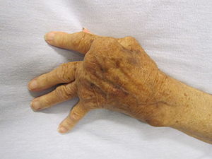 CircleCare-Rheumatoid_Arthritis