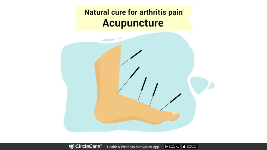 acupuncture-for-arthritis-cure-treatment-pain-management-circlecare