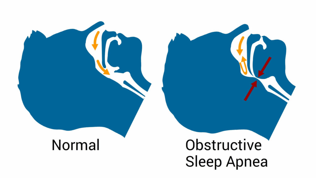 cause-of-hypertension-Obstructive-sleep-apnea-CircleCare
