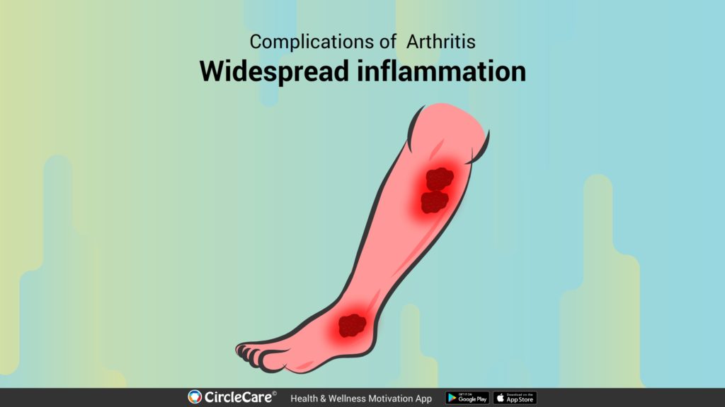 widespread-inflammation-complications-caused-by-arthritis-circle-care