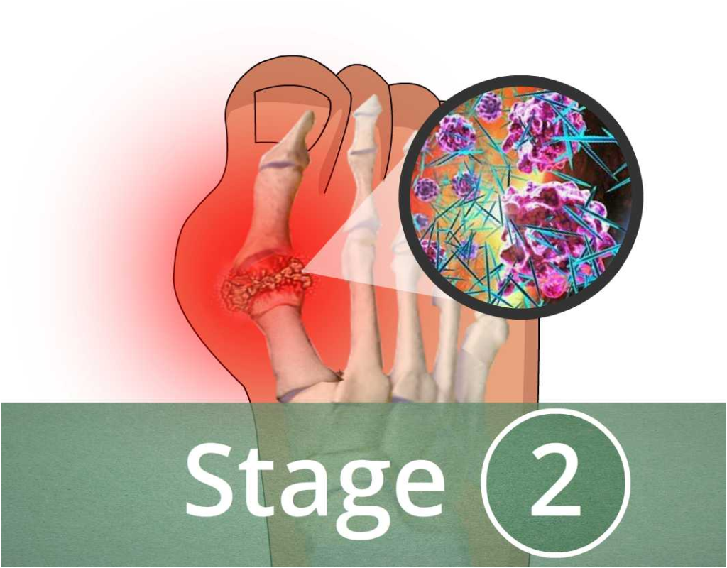 acute-gout-attack-circlecare