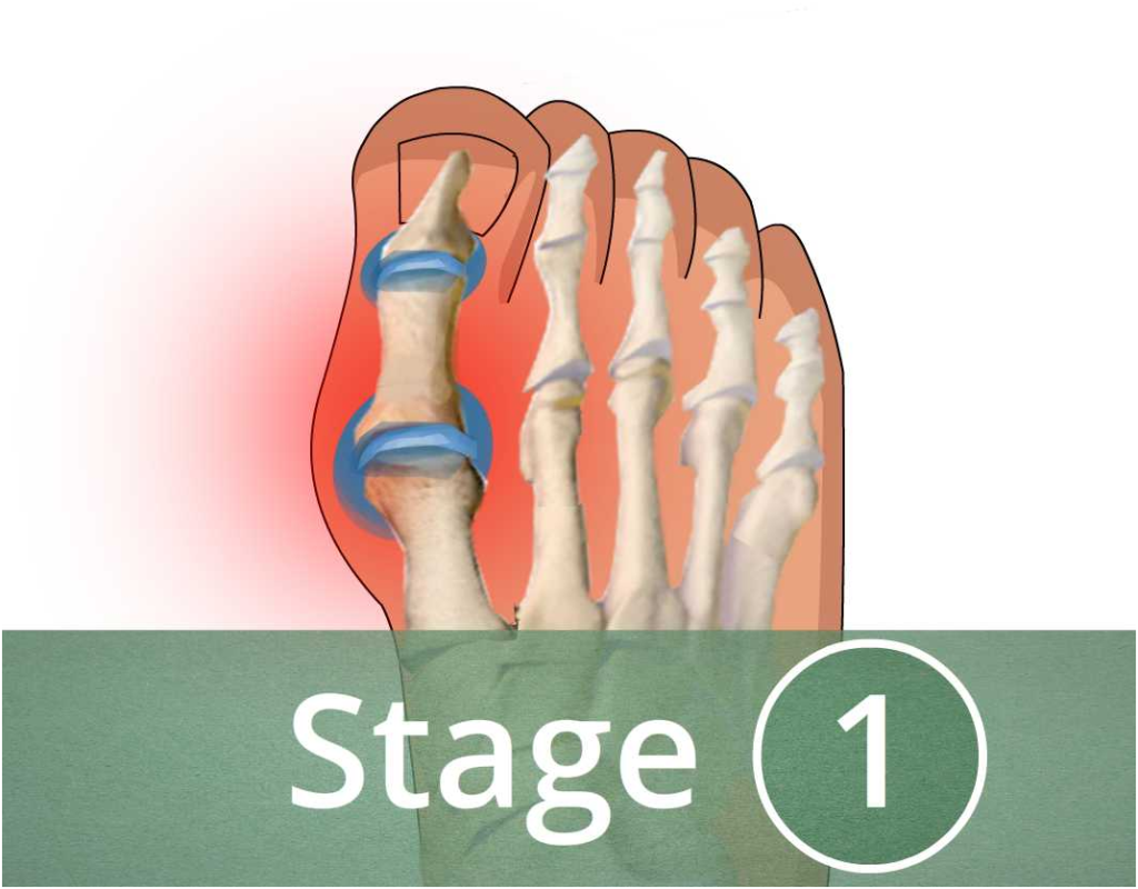 asymptomatic-hyperuricemia-circlecare