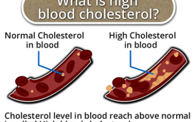 What is high blood cholesterol?