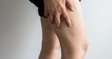 The 5 signs of vein disease that you shouldn't ignore