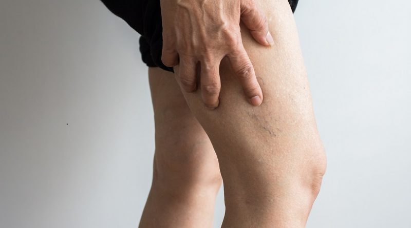 The 5 signs of vein disease that you shouldn't ignore