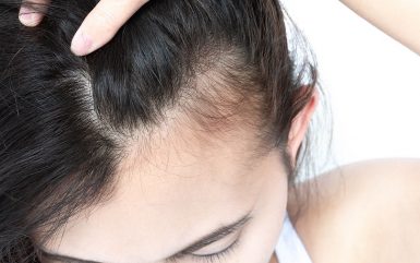 How is Hair Loss in Women Different than in Men?
