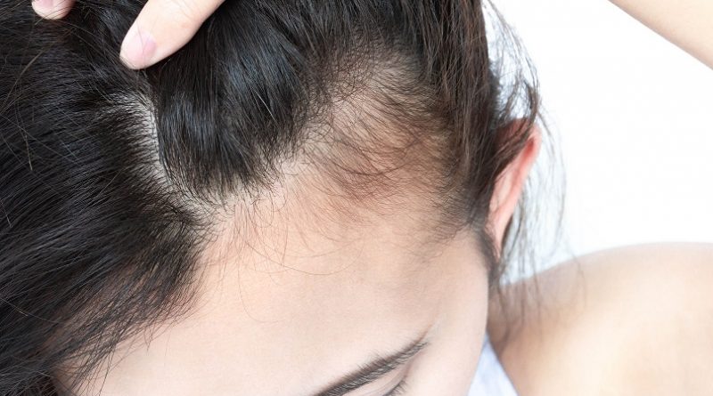 How is Hair Loss in Women Different than in Men