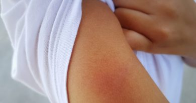 5 Tips to Take Care of Early Rash