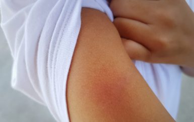 5 Tips to Take Care of Early Rash