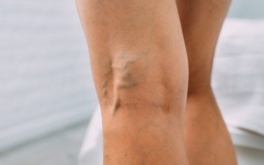 Varicose and Spider Veins: Causes, Symptoms, and Treatments