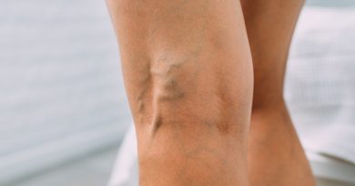 Varicose and Spider Veins Causes, Symptoms, and Treatments
