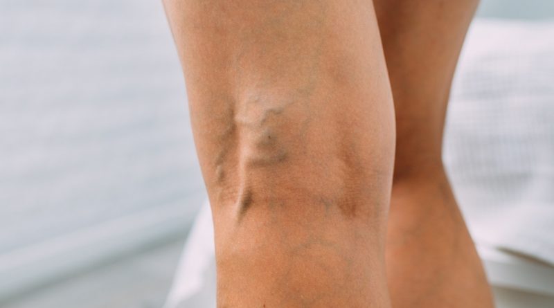 Varicose and Spider Veins Causes, Symptoms, and Treatments