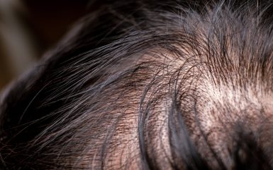 4 Ways to Hide Thinning Hair