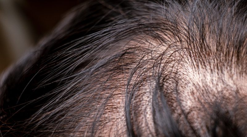 4 Ways to Hide Thinning Hair